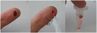 Assessing Volumetric Absorptive Microsampling Coupled with Stable Isotope Dilution Assay and Liquid Chromatography–Tandem Mass Spectrometry as Potential Diagnostic Tool for Whole Blood 5-Methyltetrahydrofolic Acid